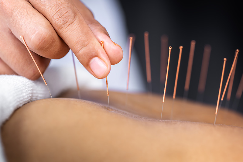 An acupuncturist in NYC gently inserting needles to help relieve anxiety symptoms.