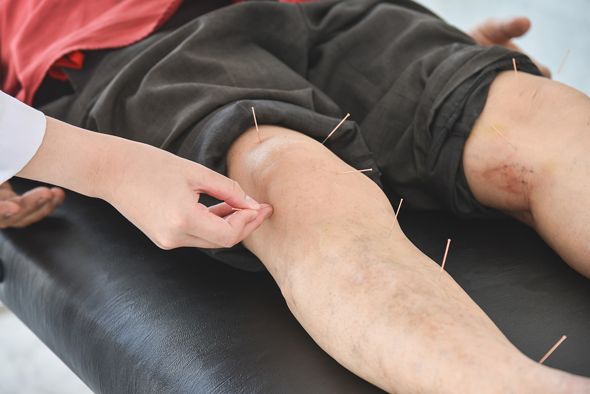 A man receiving acupuncture on his knee and legs for pain relief and swelling.