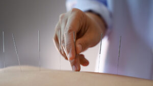 Closeup of an acupuncture treatment