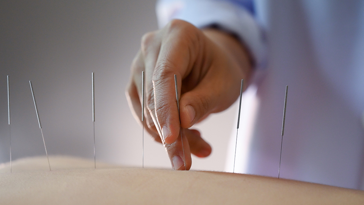 Closeup of an acupuncture treatment