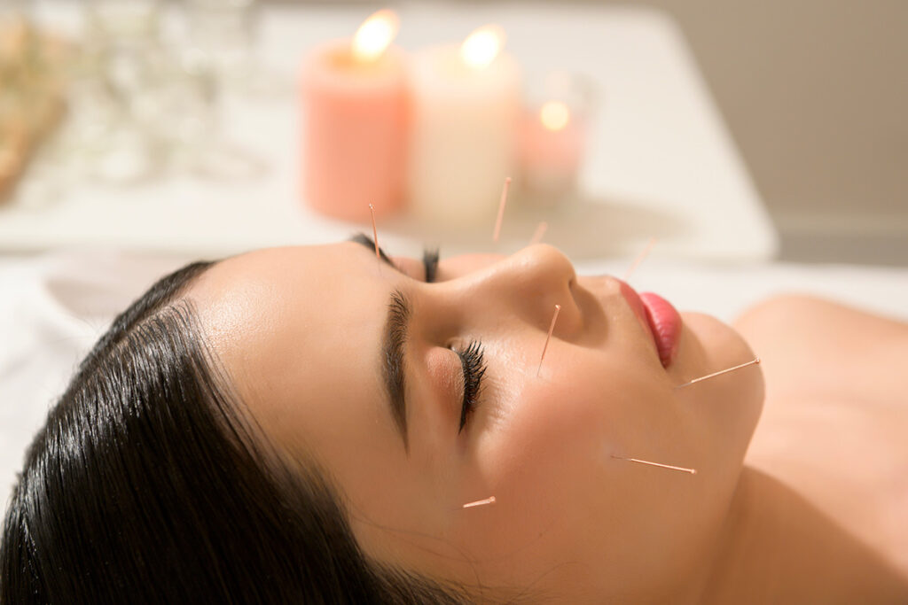 Relaxing acupuncture treatment for stress relief