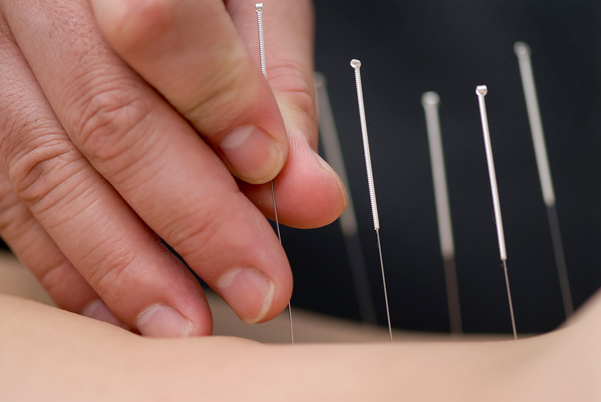 Treatment by acupuncture